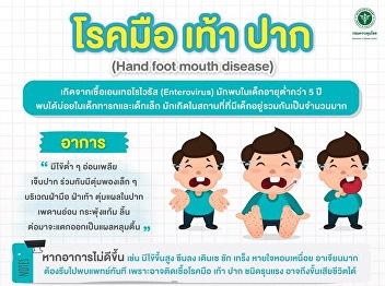 Hand foot mouth disease is caused by
enteroviruses. (Enterovirus)